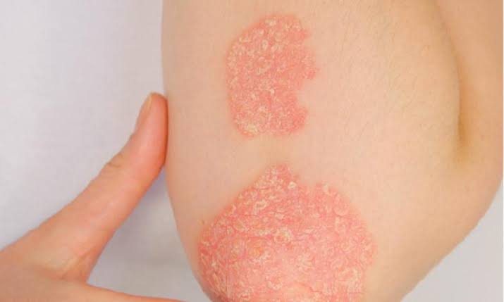 Psoriasis Package